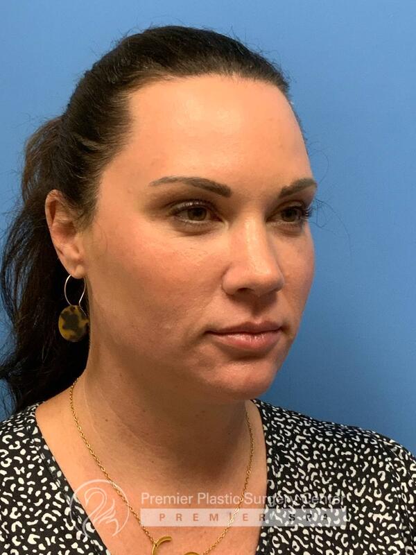 Fillers Before & After Image