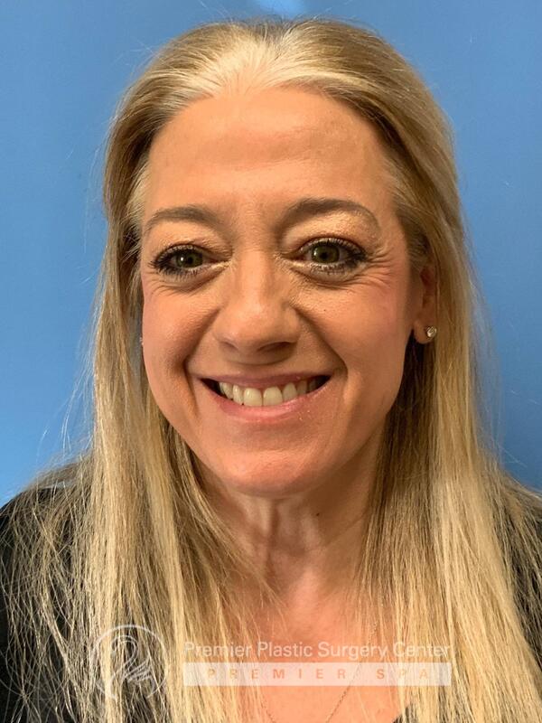 Fillers Before & After Image