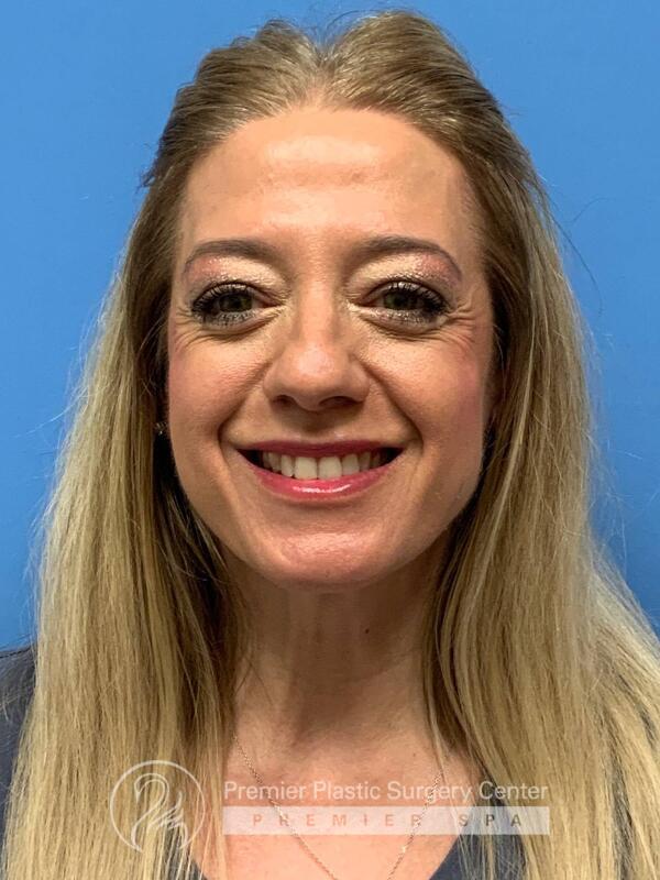 Fillers Before & After Image