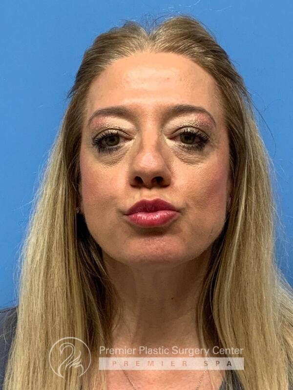 Fillers Before & After Image