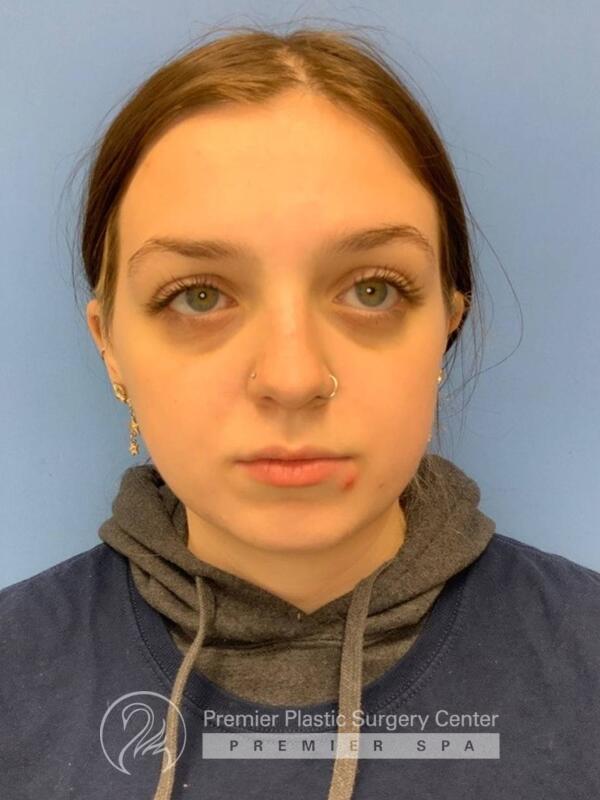 Fillers Before & After Image