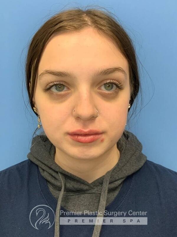 Fillers Before & After Image