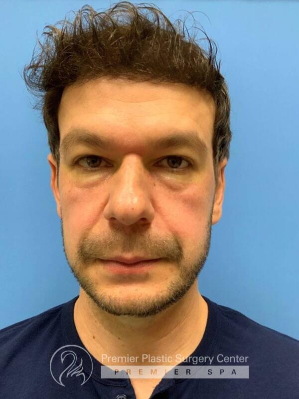 Fillers Before & After Image