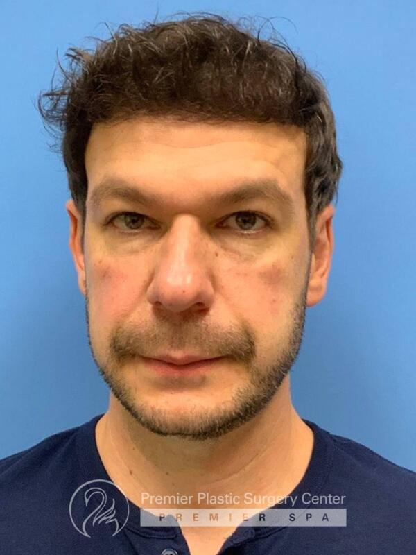 Fillers Before & After Image