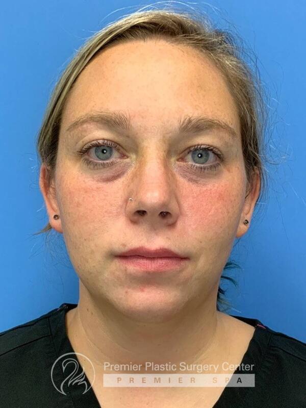 Fillers Before & After Image