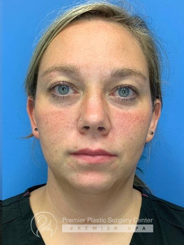 Fillers Before & After Image