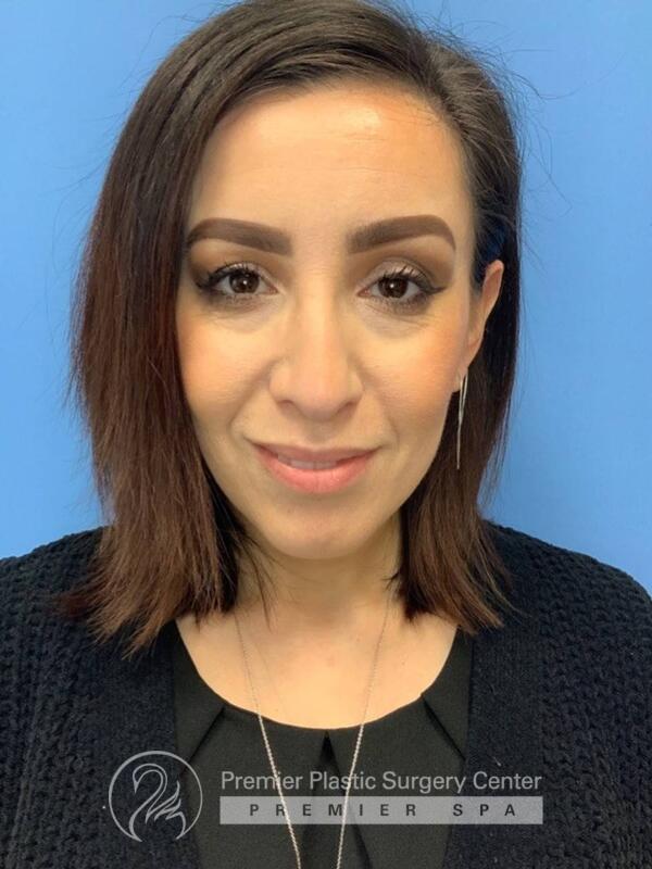 Fillers Before & After Image