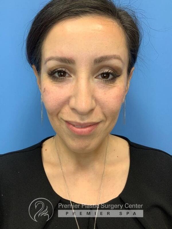 Fillers Before & After Image