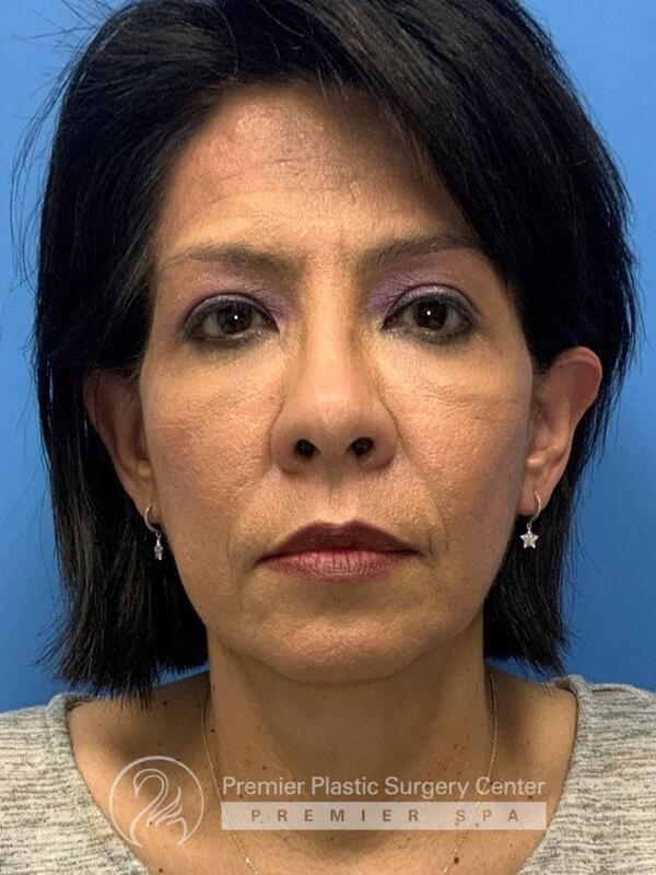 Fillers Before & After Image