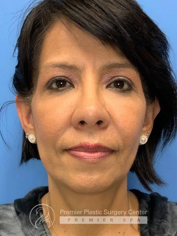 Fillers Before & After Image