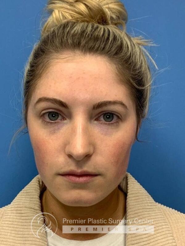Fillers Before & After Image