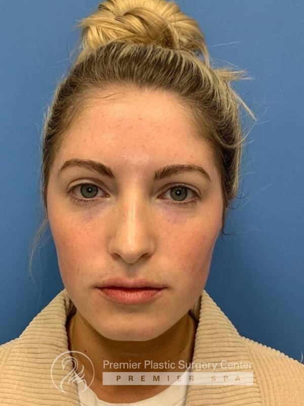 Fillers Before & After Image
