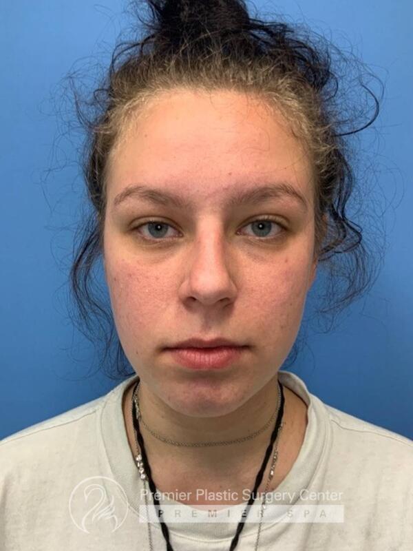 Fillers Before & After Image