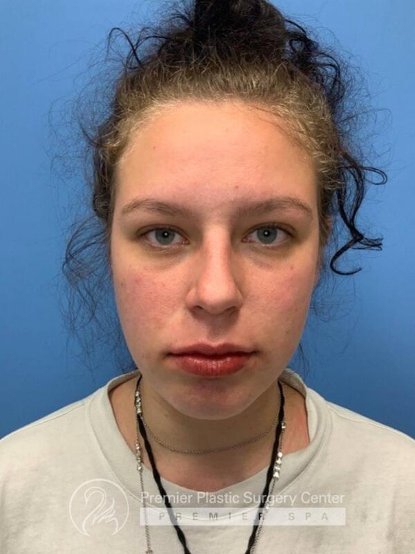 Fillers Before & After Image