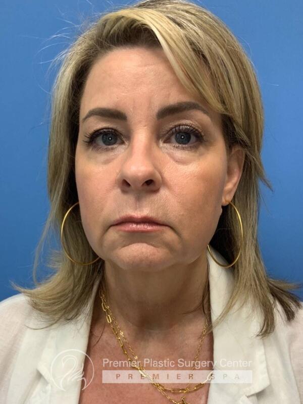 Fillers Before & After Image