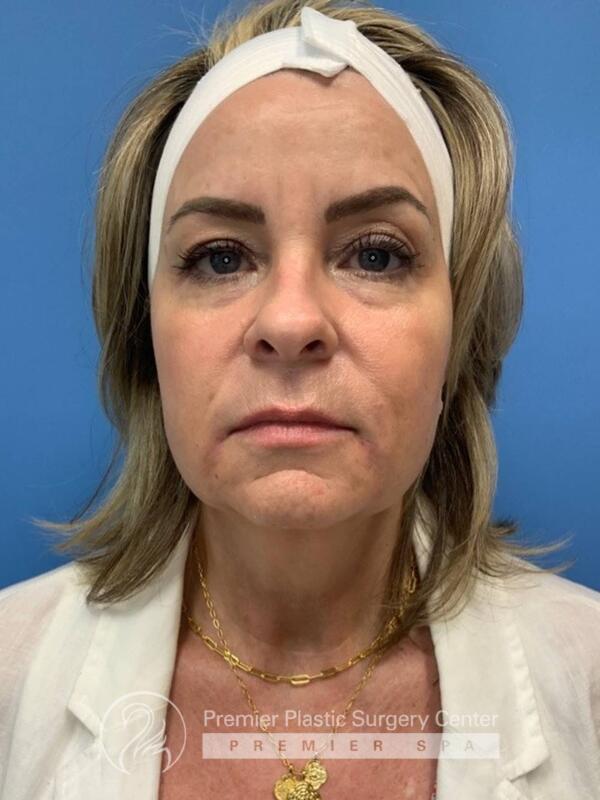 Fillers Before & After Image