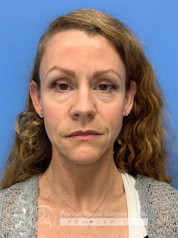 Fillers Before & After Image