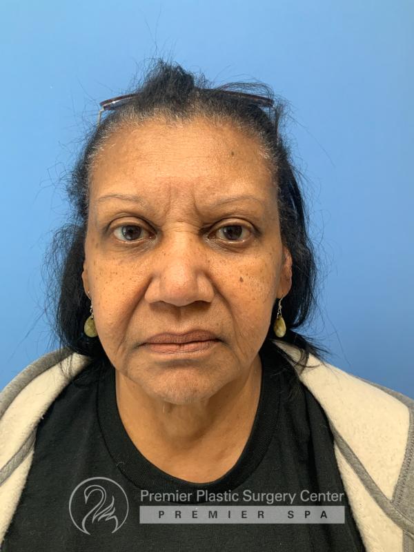 Fillers Before & After Image