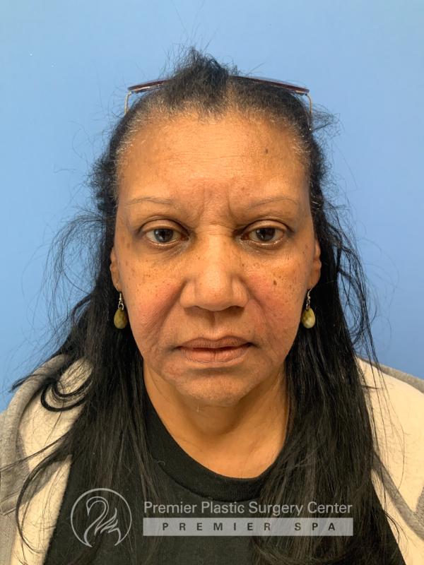 Fillers Before & After Image