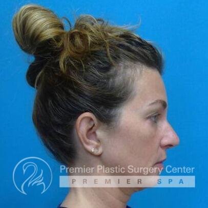 Microneedling Before & After Image