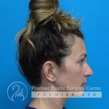 Microneedling Before & After Image