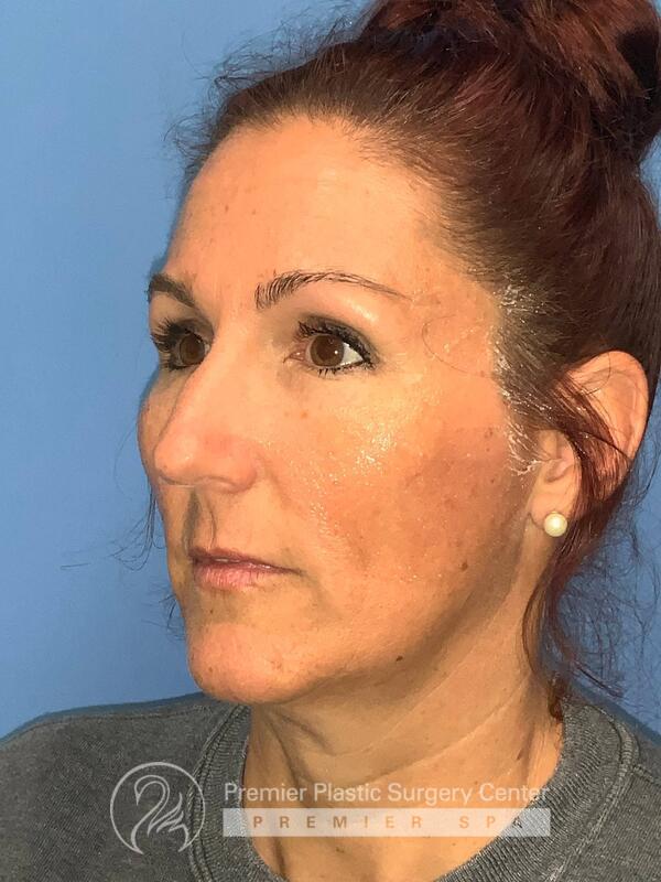 Sculptra Before & After Image