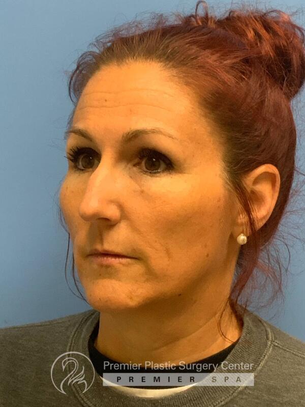 Sculptra Before & After Image