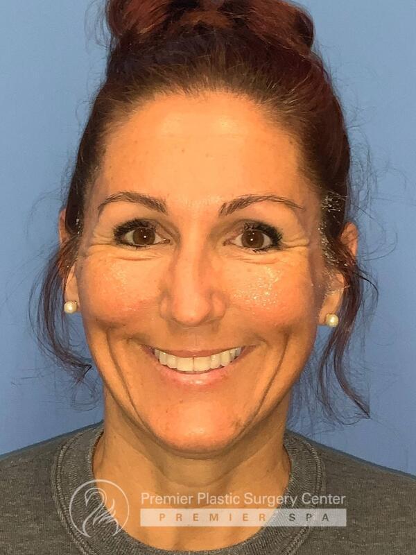 Sculptra Before & After Image
