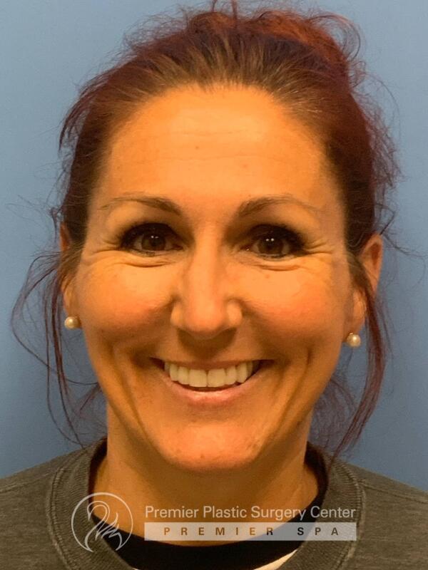 Sculptra Before & After Image