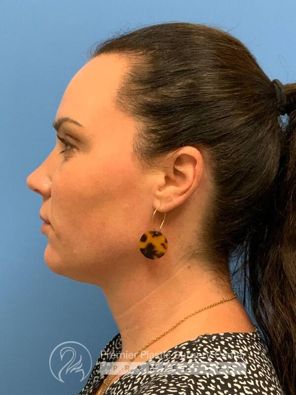 Sculptra Before & After Image