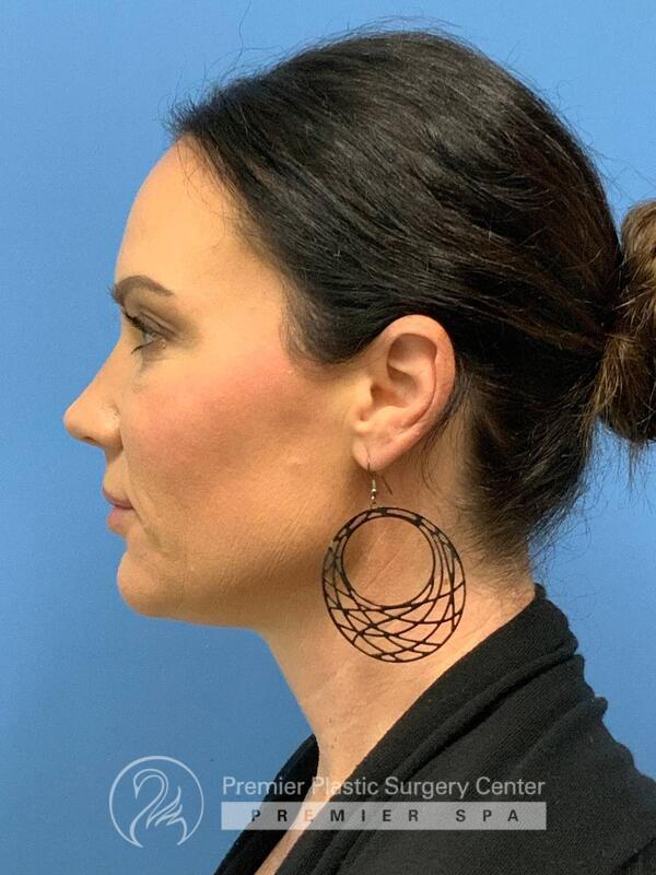 Sculptra Before & After Image