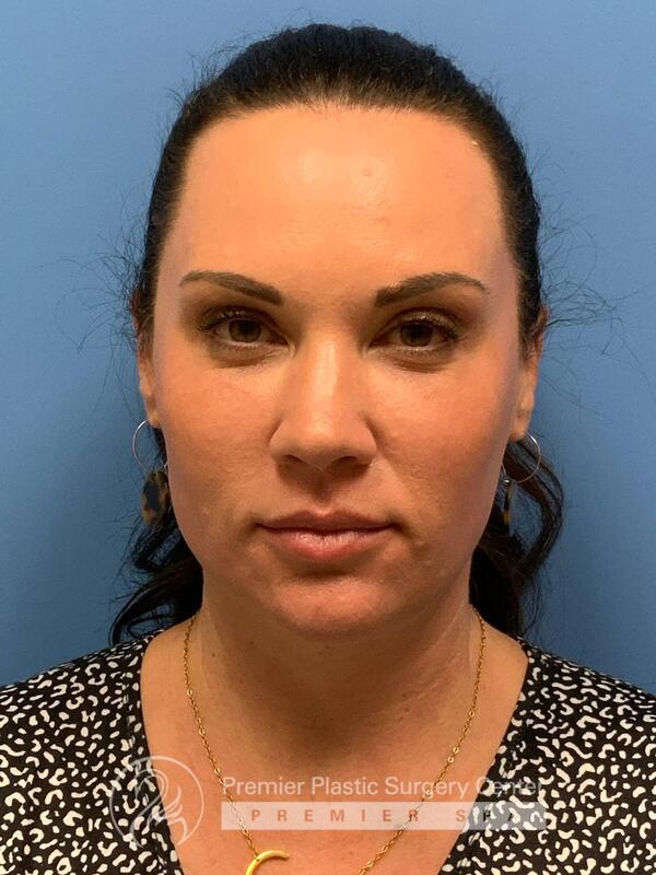 Sculptra Before & After Image