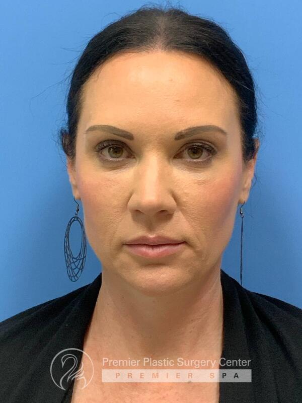Sculptra Before & After Image