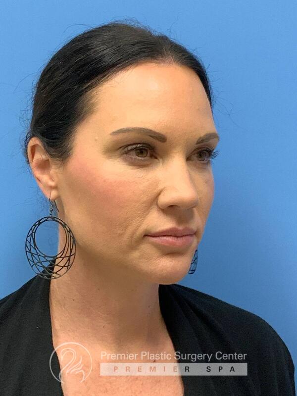 Sculptra Before & After Image