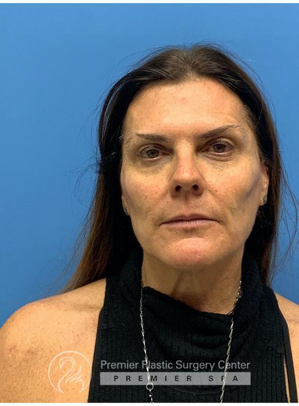 Sculptra Before & After Image