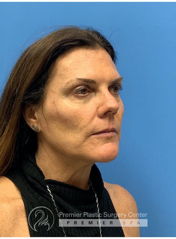 Sculptra Before & After Image