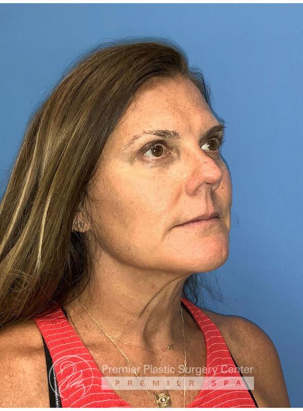 Sculptra Before & After Image