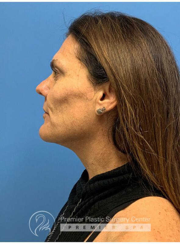 Sculptra Before & After Image