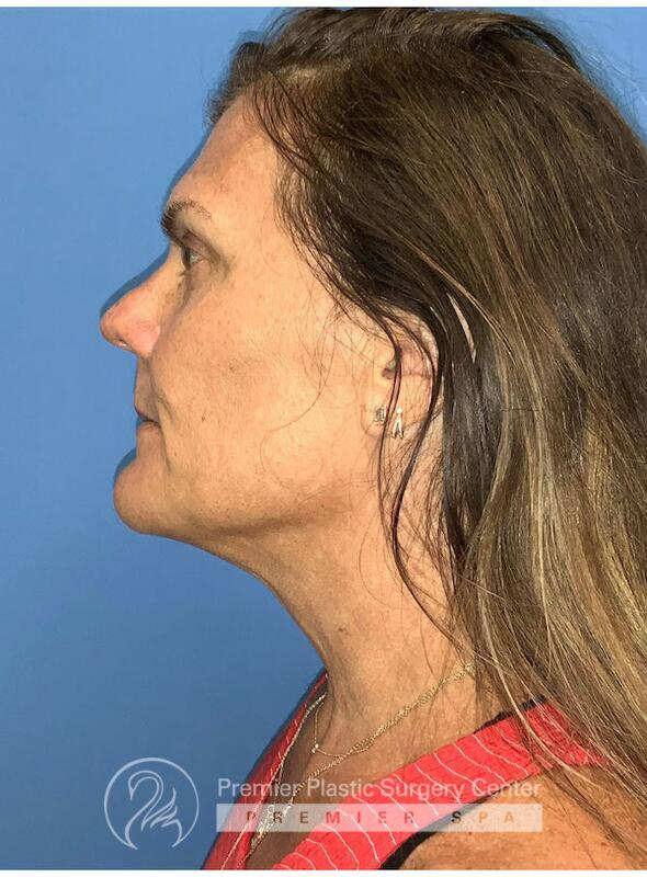Sculptra Before & After Image