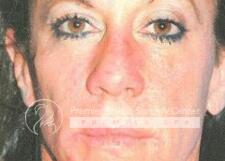 Sculptra Before & After Image