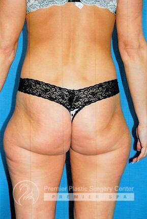 Brazillian Butt Lift Before & After Image