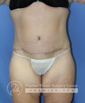Skin Removal After Weight Loss Before & After Image