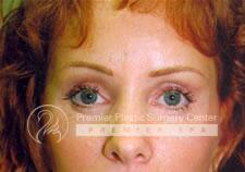 Brow Lifts Before & After Image