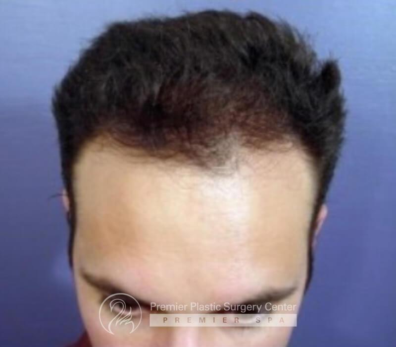 Neograft Hair Transplant Before & After Image