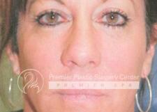 Sculptra Before & After Image
