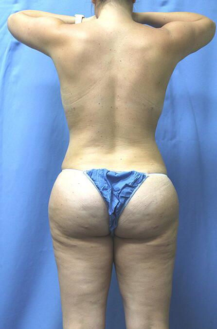 Brazillian Butt Lift Before & After Image