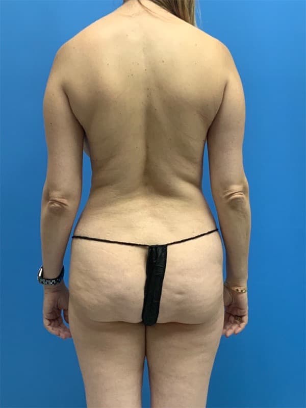 Liposuction Before & After Image