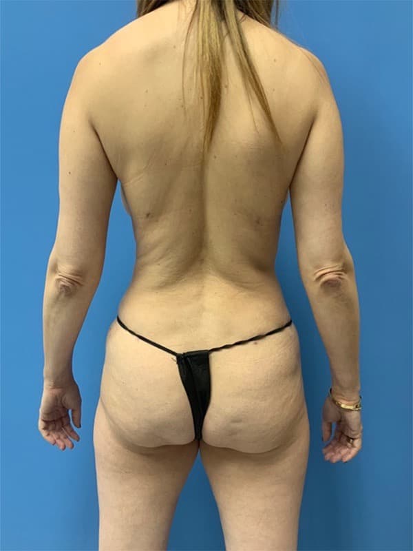 Liposuction Before & After Image