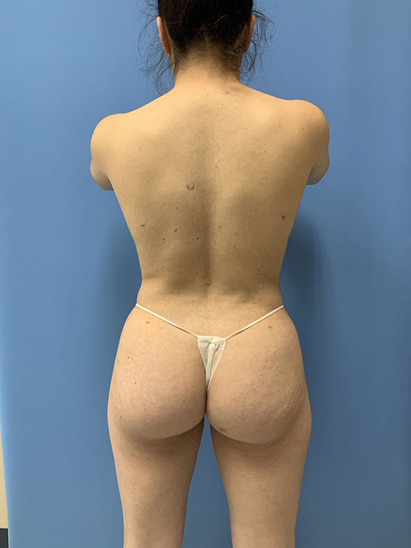 Liposuction Before & After Image