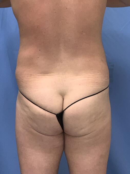 Liposuction Before & After Image